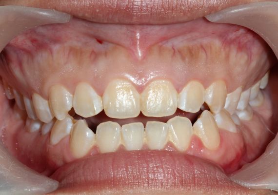 A close-up of an open bite