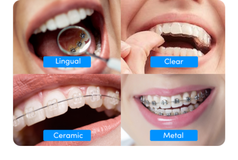 Types of braces explained: Choose the right one for you
