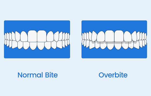 What is an overbite