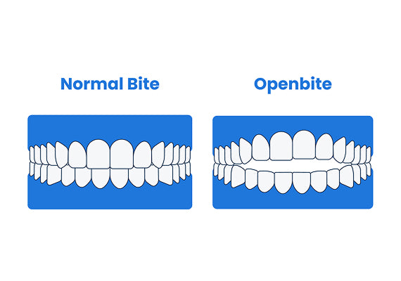 An illustration showing a normal bite and an open bite.