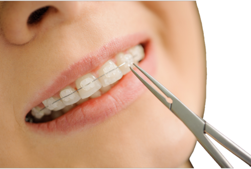 How long does it take to get ceramic braces put on?