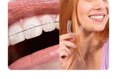 Why more adults are choosing clear braces in 2025