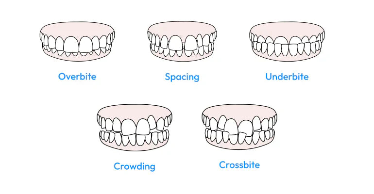 Illustrations of types of malocclusions