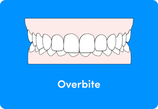 An illustration showing an overbite.
