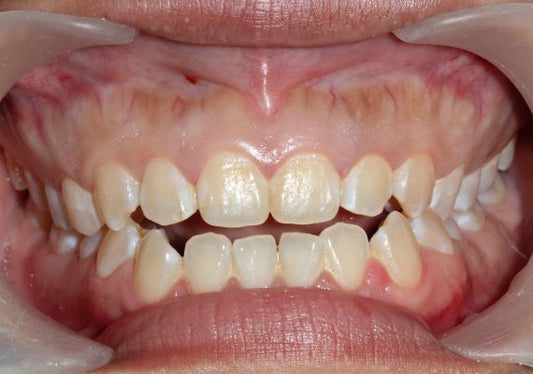 A close-up of an open bite