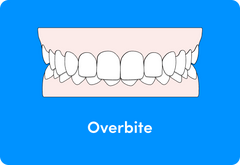 Do aligners fix overbites better than braces