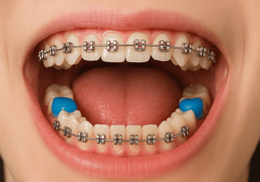 Bite block braces placed on posterior teeth