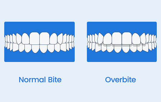What is an overbite