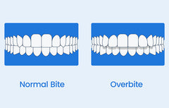 What is an overbite