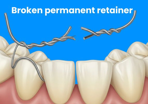 How to Handle a Broken Permanent Retainer – Tips & Solution