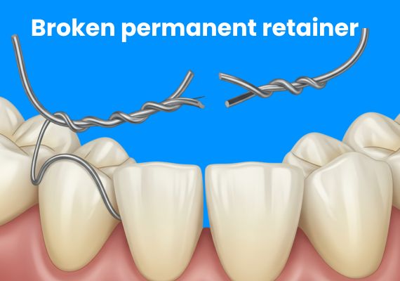 Broken permanent retainer on a blue background