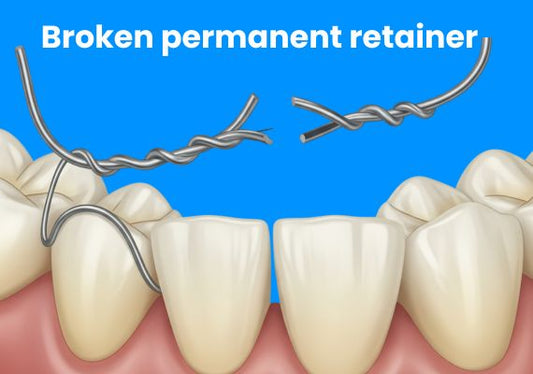 Broken permanent retainer on a blue background