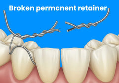 Broken permanent retainer – what to do and what to expect