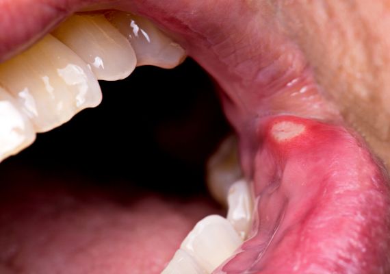  Close-up of a person showing a canker sore in their mouth