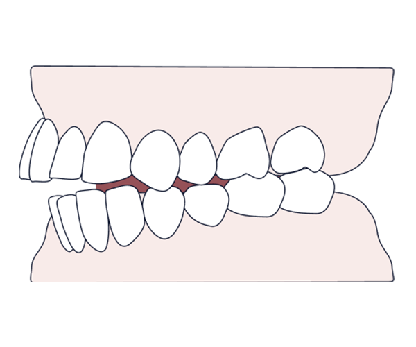 Understanding overjet – causes, treatment, and why treating it matters