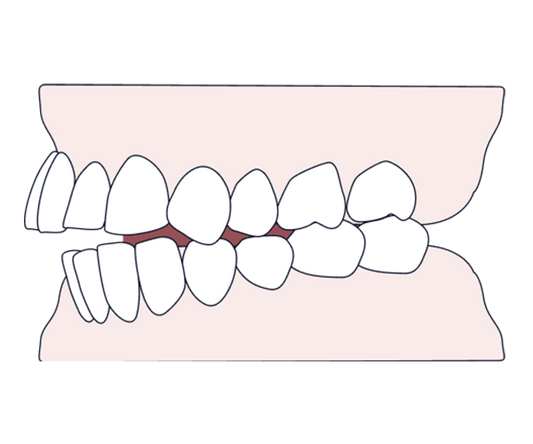 Understanding overjet – causes, treatment, and why treating it matters