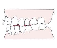 Understanding overjet – causes, treatment, and why treating it matters