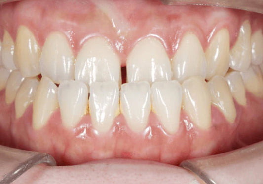  A close-up image of a crossbite.