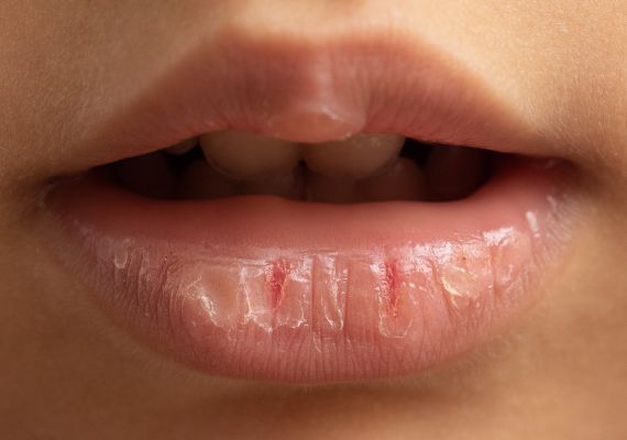 Close-up of dry lips and mouth