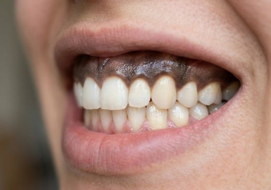 Close-up of a person's smile showcasing dark hyperpigmentation on the gums.