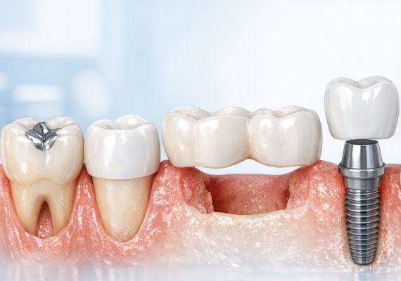different tooth restoration methods