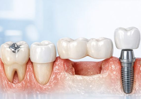 different tooth restoration methods