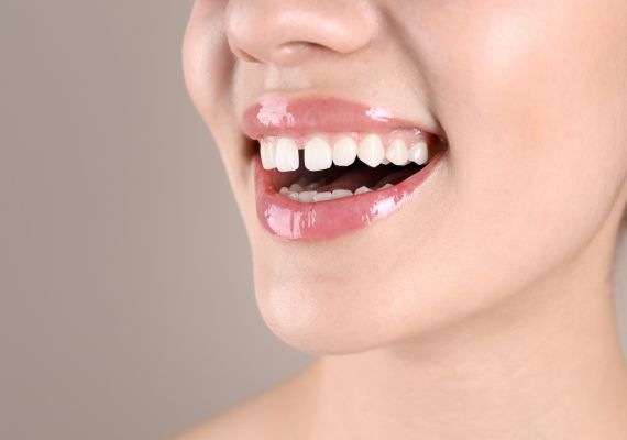 A girl smiling to show gaps in her teeth.