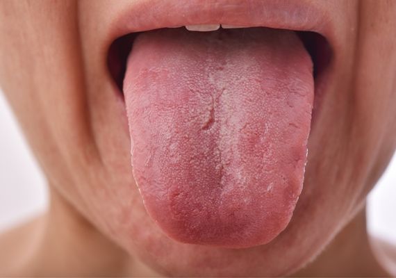 A person sticking out their tongue to show a cracked tongue