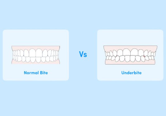 An illustration showing a side-by-side comparison between an underbite and a normal bite.