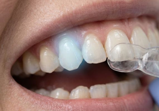 A clear dental aligner is being placed over natural upper teeth, with one sensitive tooth.