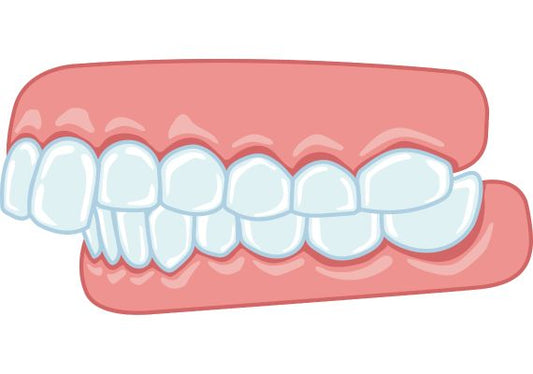 An illustration of an overbite