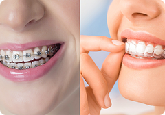 Aligners vs braces: Which one fits your budget & lifestyle?