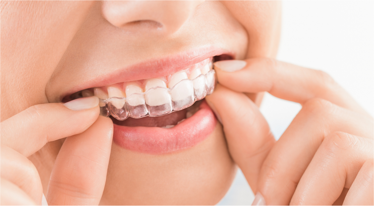  A close-up of a girl applying clear aligners.