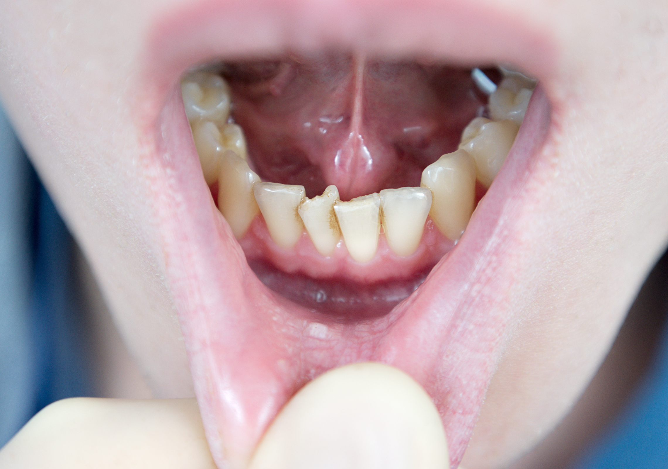 A closeup of a boy showing his crowded bottom teeth.