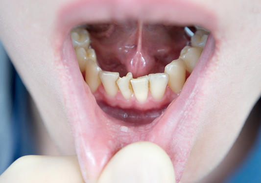 A closeup of a boy showing his crowded bottom teeth.