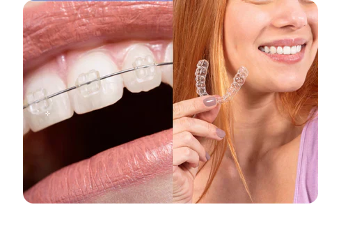 A side-by-side pictorial representation of ceramic braces and clear aligners.