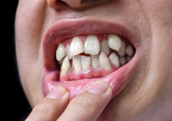 A boy shows his crowded teeth