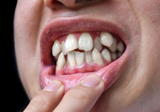 A boy shows his crowded teeth