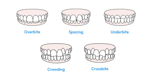 Illustrations of types of malocclusions