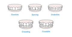 Malocclusion of the teeth – causes, symptoms, and diagnosis