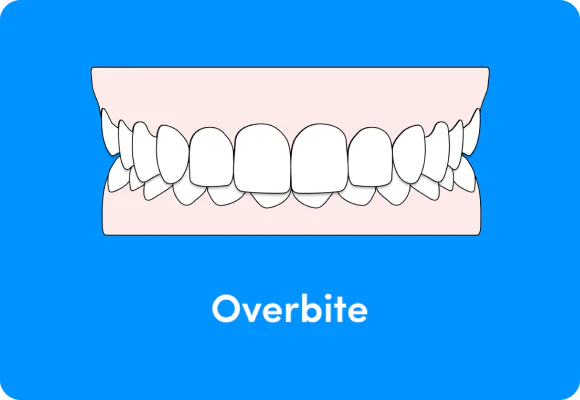 An illustration showing an overbite.