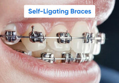 Self-ligating braces: How they differ, benefits, cost