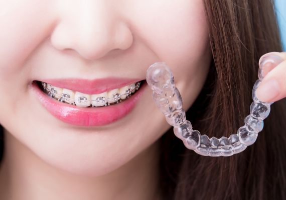 A woman wearing self-ligating braces and holding clear braces