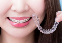 Self-ligating braces vs invisible braces: Which is right for you?