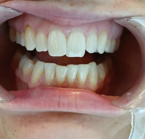 After treatment
