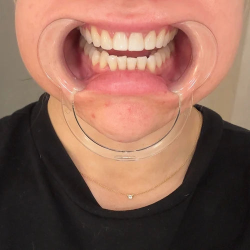 Before treatment