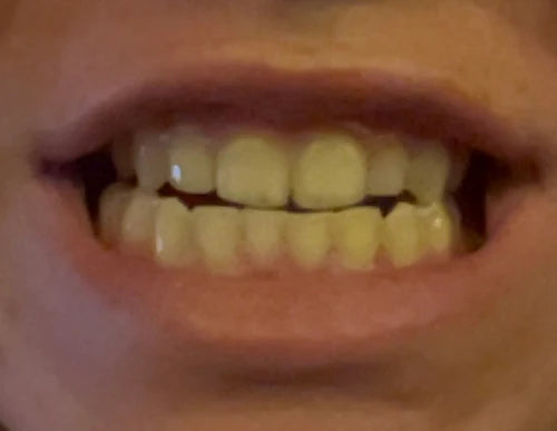 Before treatment