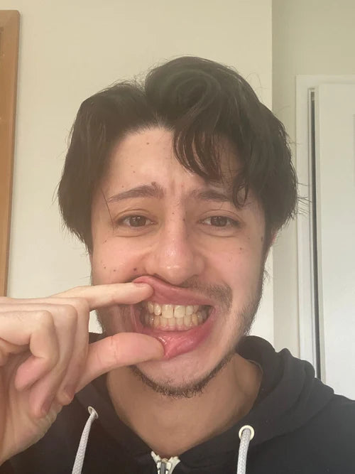 Before treatment
