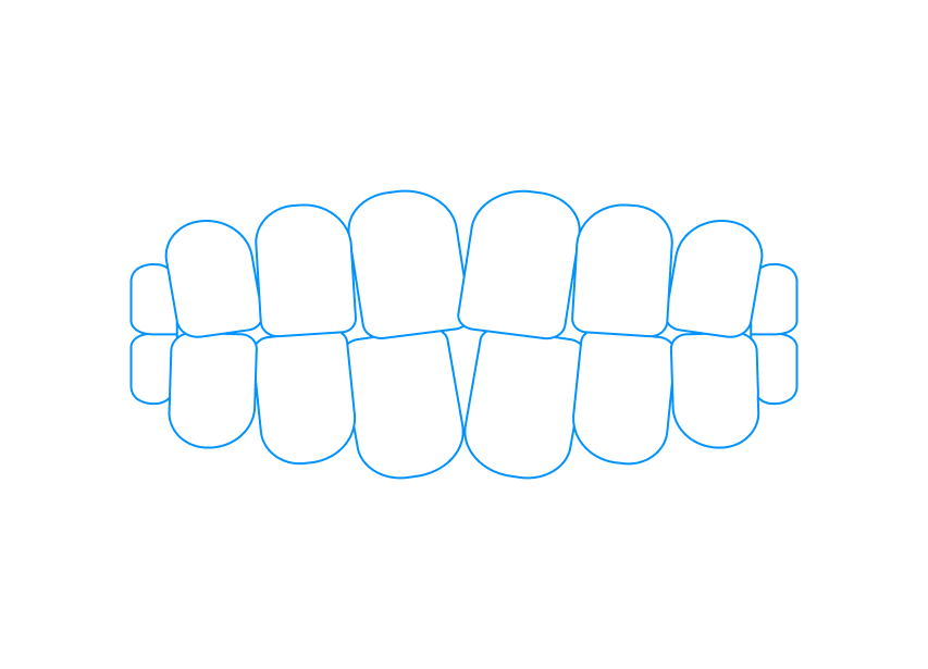 What is Crossbite?