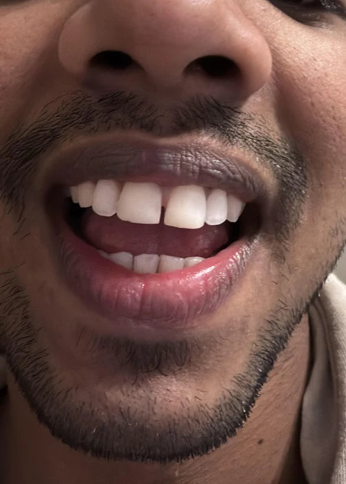 Before treatment